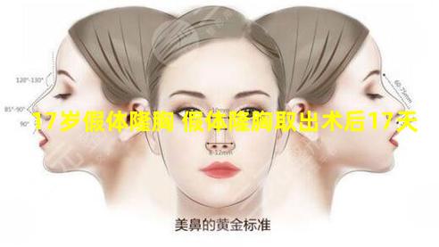 17岁假体隆胸 假体隆胸取出术后17天